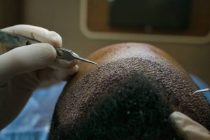 Hair Transplant